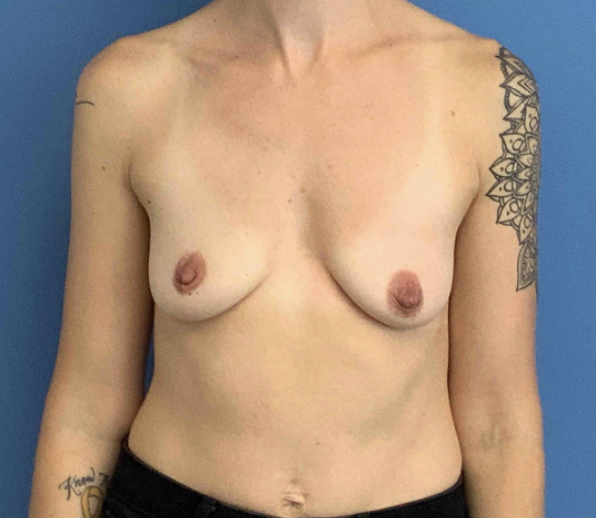 Breast-Augmentation--Case-Study-4819 | Before Breast Augmentation